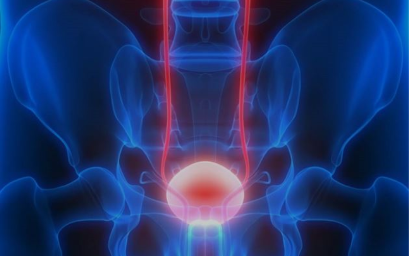 NEW Bladder cancer Assay Yes there is a NON-INVASIVE method to diagnose bladder cancer from Urine samples